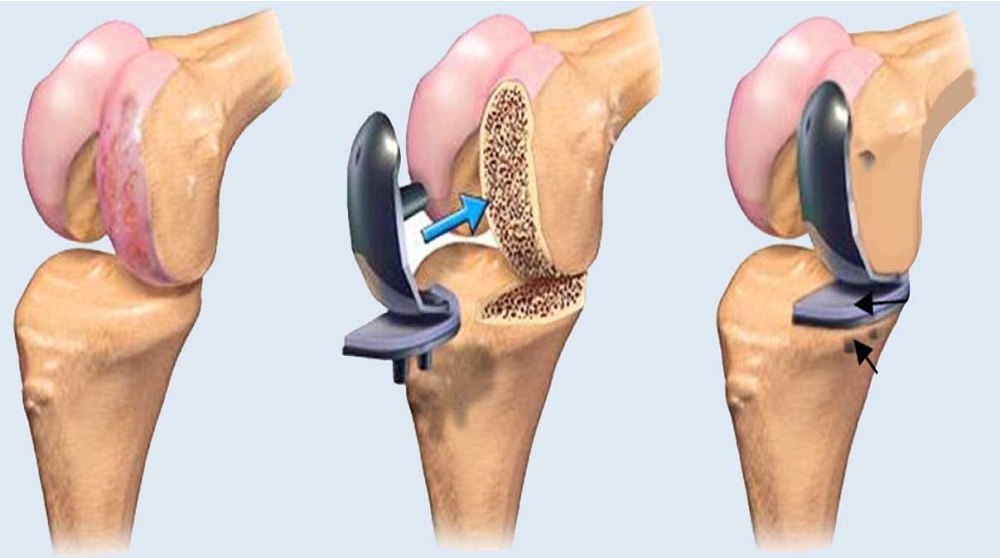 knee replacement surgery noida