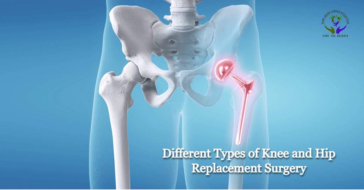 Different Types of Knee and Hip Replacement Surgery